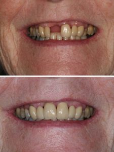 Replacement of failed front tooth with implant retained crown
