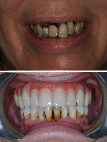 Replacement of failed upper teeth with full arch implant retained bridge