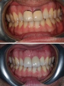 Replacement of failed left front tooth with implant retained crown